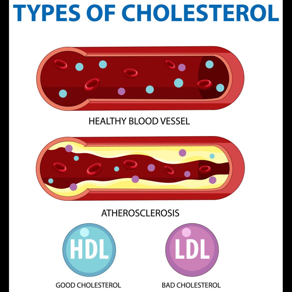 An illustration showing a healthy artery and a clogged artery. The clogged artery shows build up of cholesterol.
